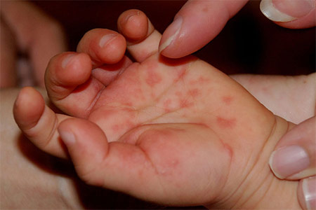Straight, No Chaser: Quick Tips - Rashes on Your Palms and Soles - Pay Attention! - Jeffrey Sterling, MD Straight, No Chaser: Quick Tips - Rashes on Your Palms and Soles - Pay Attention! - Jeffrey Sterling, MD