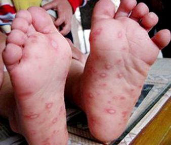 hand-foot-mouth-disease1