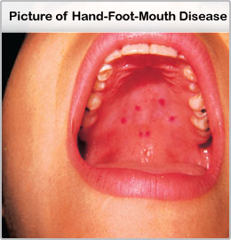 hand-foot-mouth