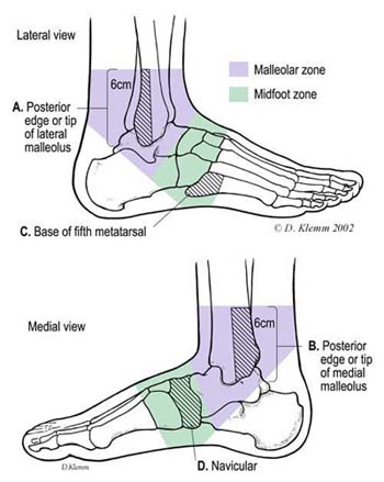 Ottawa-ankle-rules