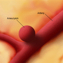 unruptured-aneurysm