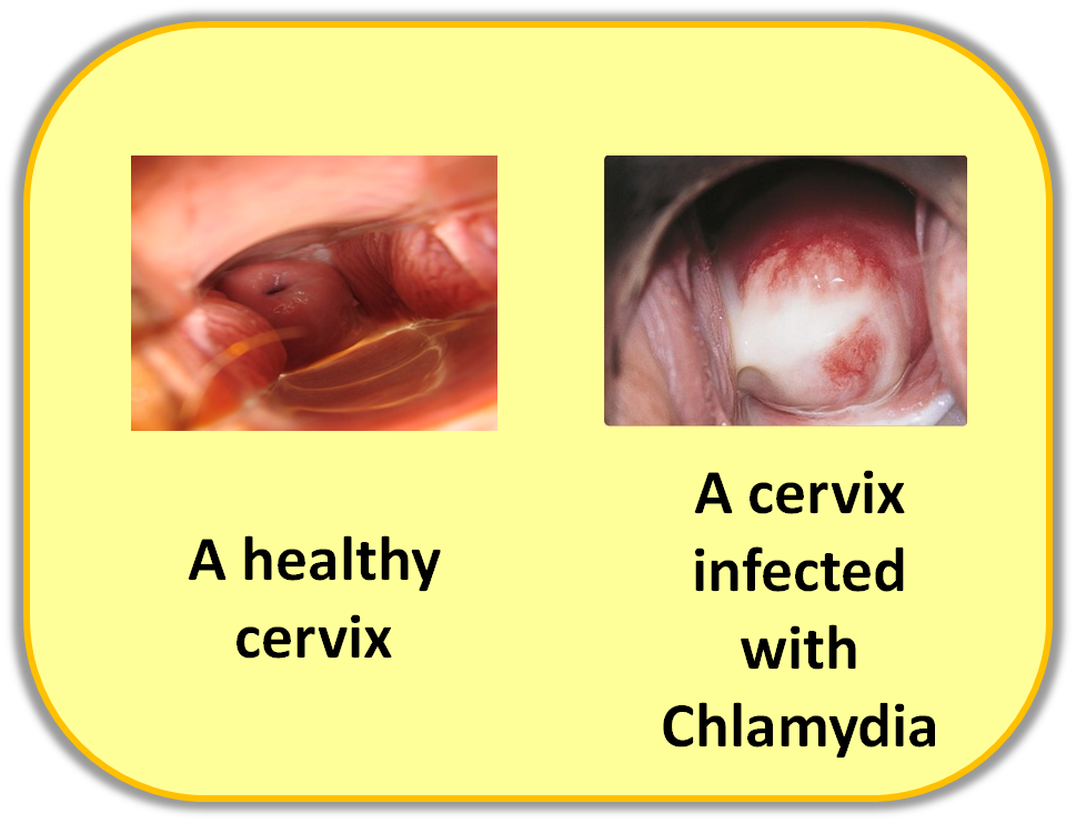 chlamydia std