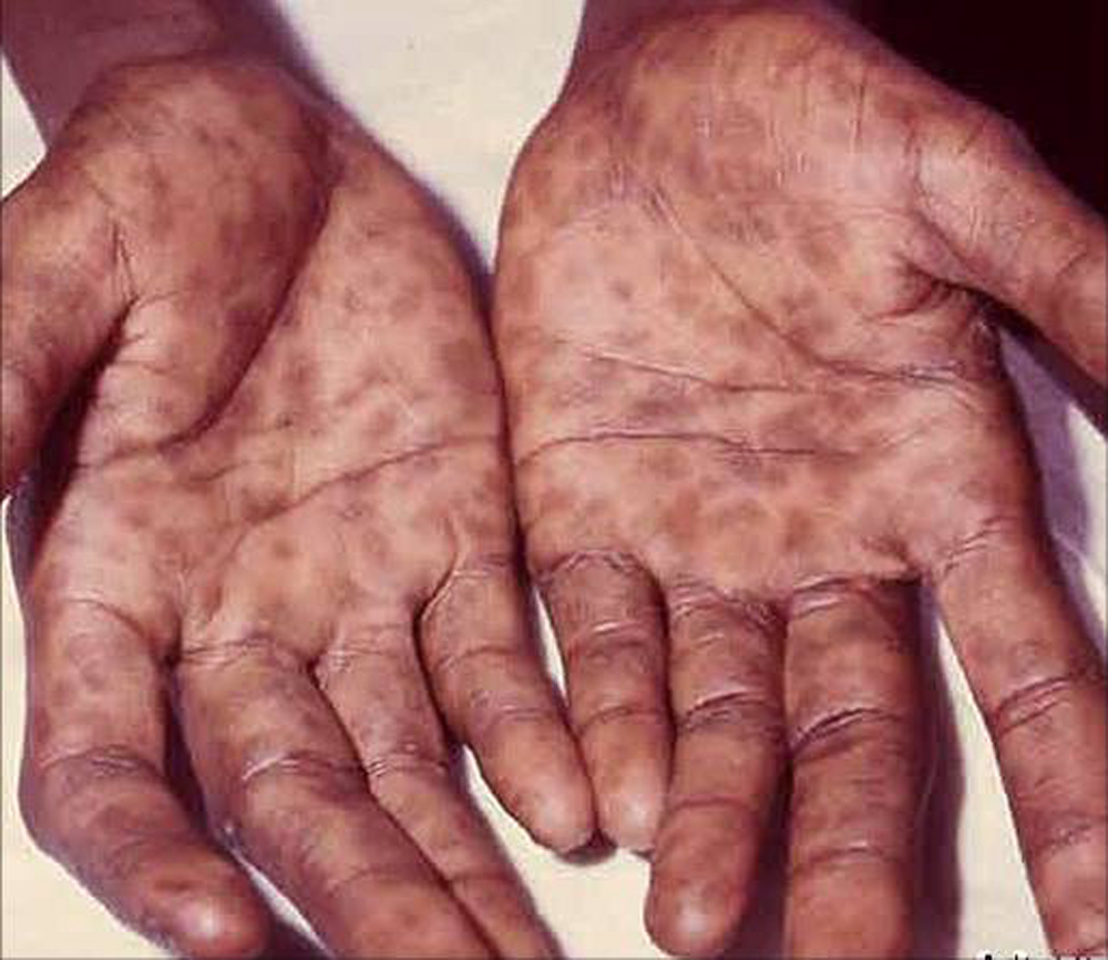 Syphilis-hands