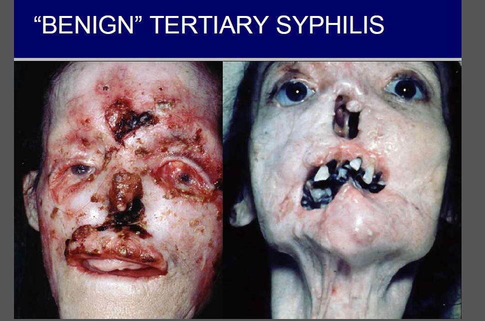 Syphilis3