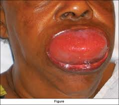 angioedema lips