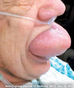 angioedema tongue