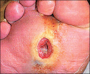 DM foot ulcer