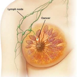 stage-2-breast-cancer