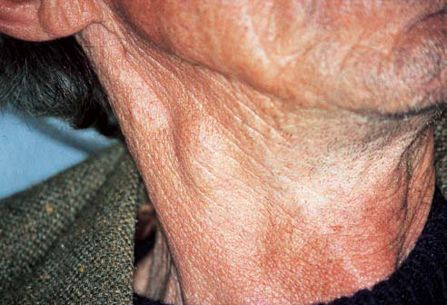 cervical lymph-node swelling from a posterior lateral squamouscell