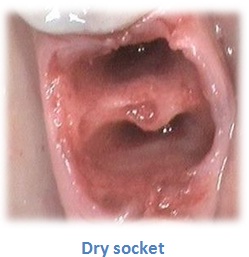 dry socket(1)