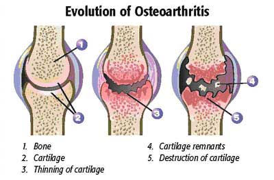 osteoarthritis