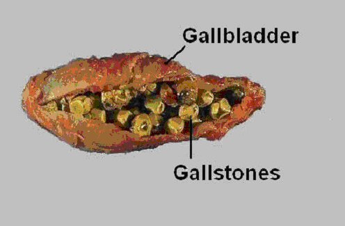 gallbladder2