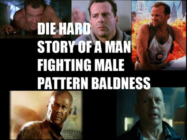 die-hard-story-of-a-man-fighting-male-pattern-baldness