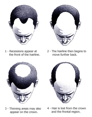Male-Pattern-Baldness