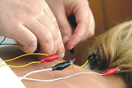 acupunctureelectrodes