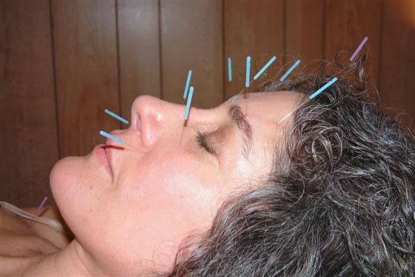 Acupunctureface