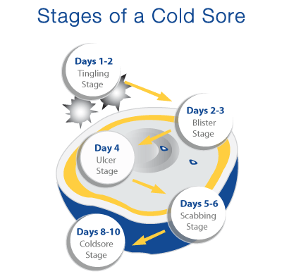 cold-sores-stages