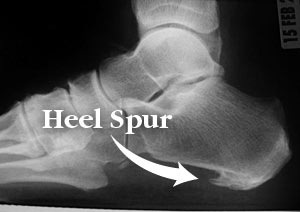 heel-bone-spur