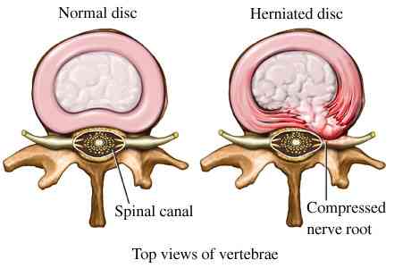 Herniated-Disc
