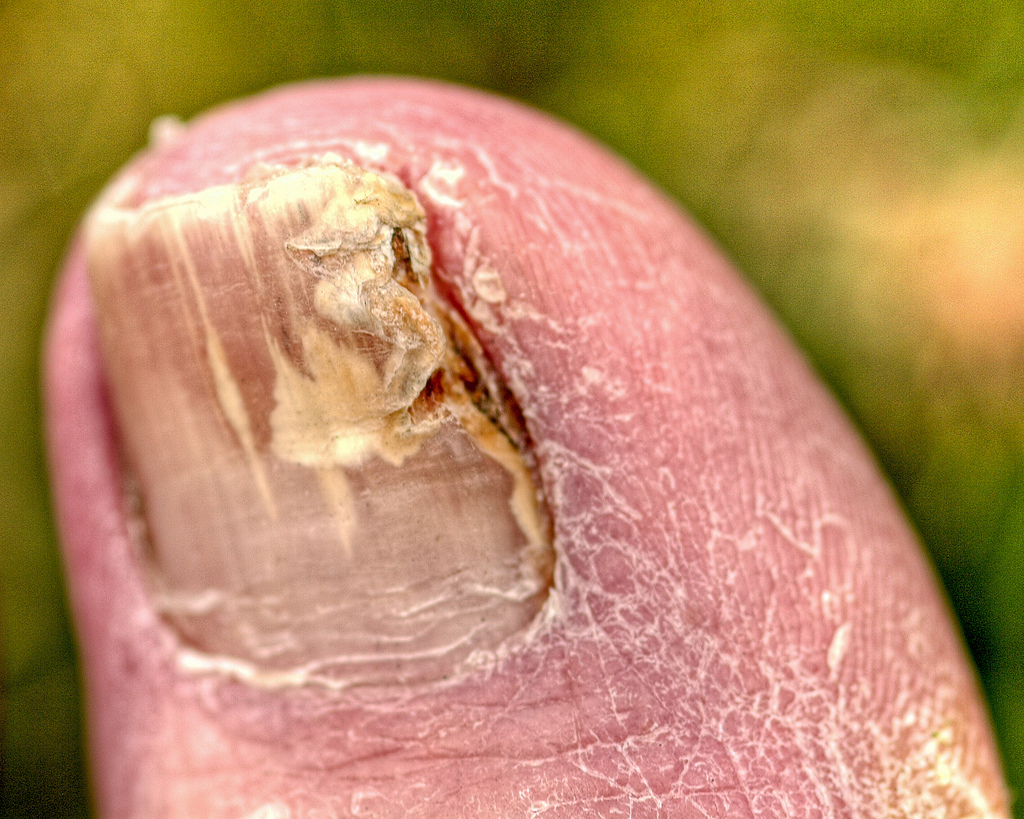 toenail-fungus