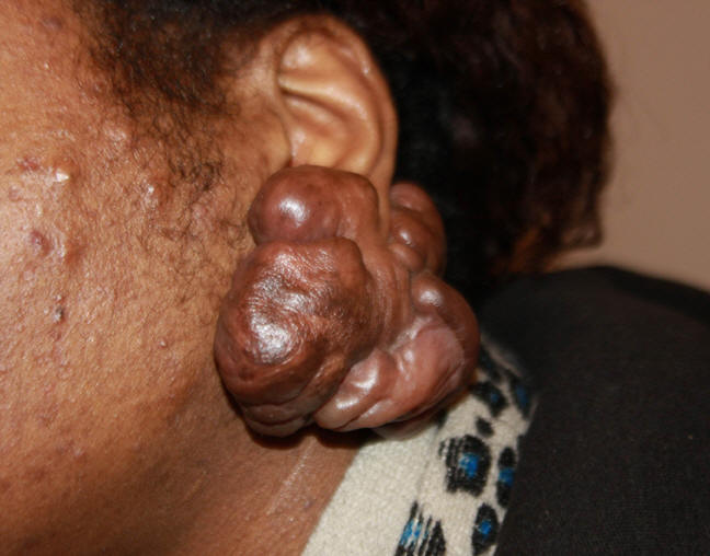 keloid2