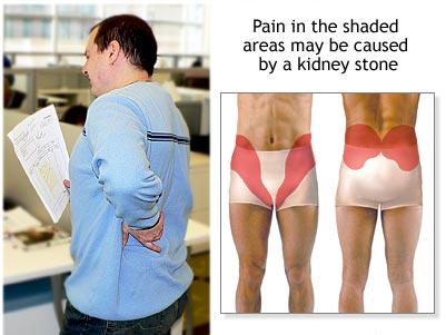 kidney-stone-pain-areas