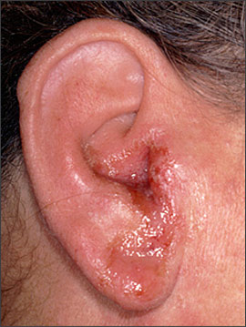 swimmers ear