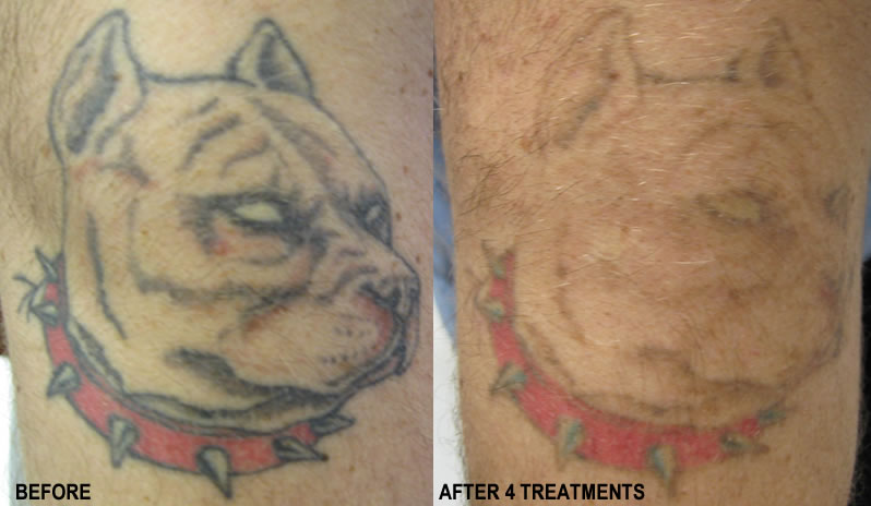 PicoSure Laser vs Tattoo Vanish Tattoo Removal TATTOOREGRETCA