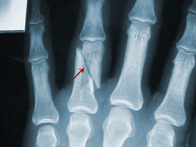 open fracture x ray