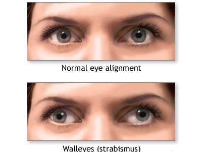 strabismus-wall-eyes