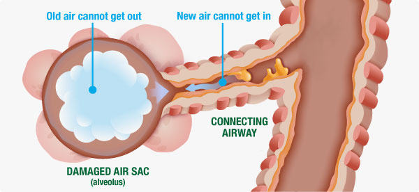 emphysema