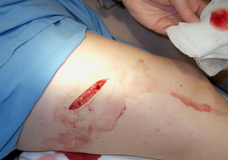 laceration wound