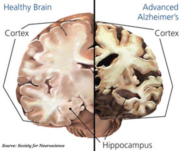 brain health unhealthy brain