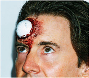golfball in forehead