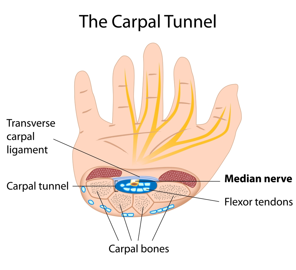 Carpal-tunnel-syndrome-picture