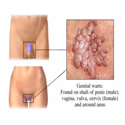 HPV genital warts