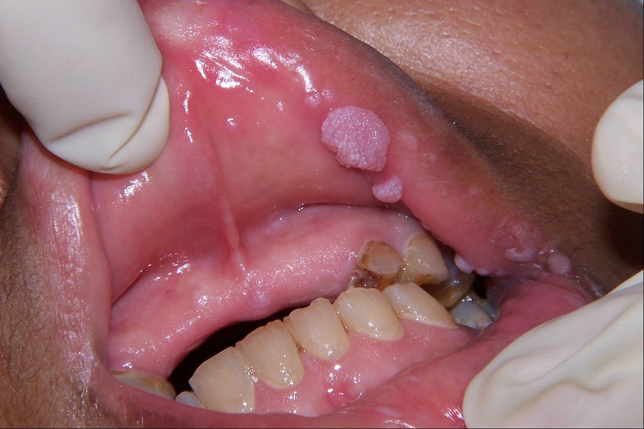 HPV oral