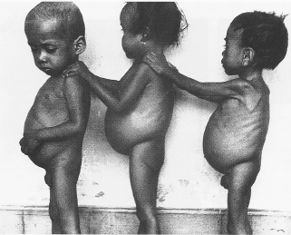malnutrition Kwashiorkor