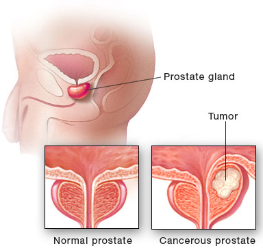 Prostate NormalCancer