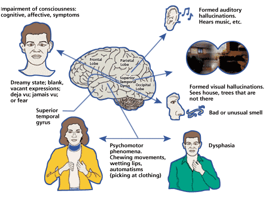 Seizures epilepsy symptoms