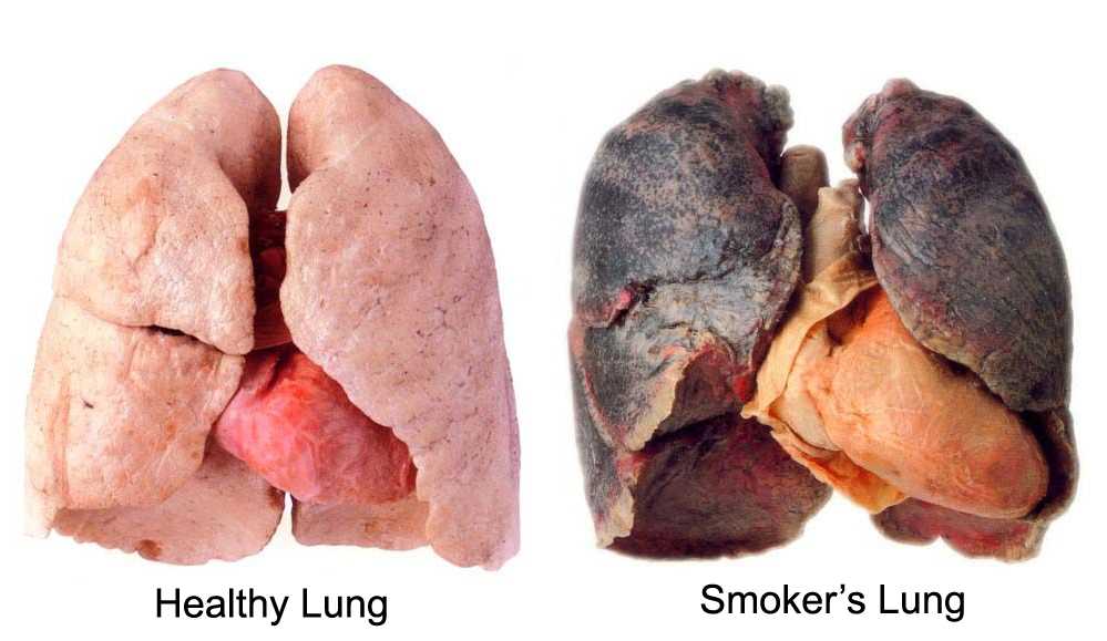bronchitis smokers-lungs_1