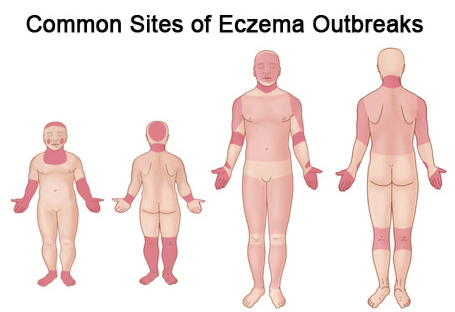 eczema-2