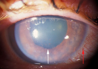 acute-angle-closure-glaucoma_3