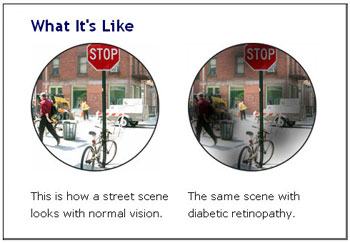 diabetic retinopathy vision