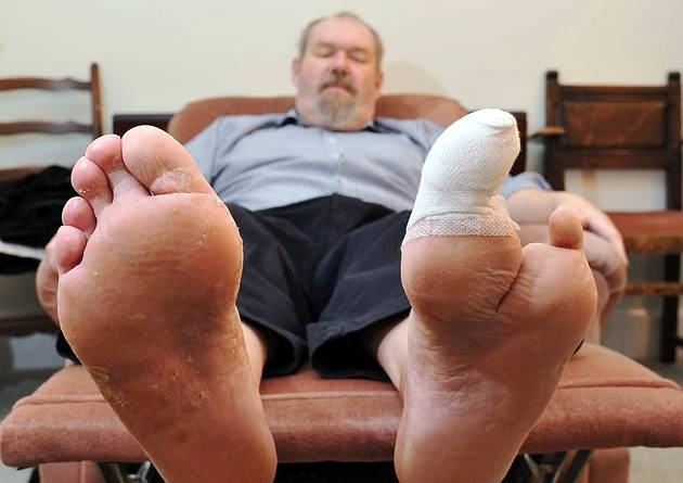 diabetic toe amputation