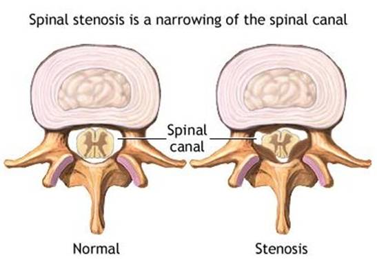 sciatica spinal stenosis