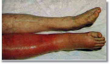 Deep-Vein-Thrombosis-Homeopathic