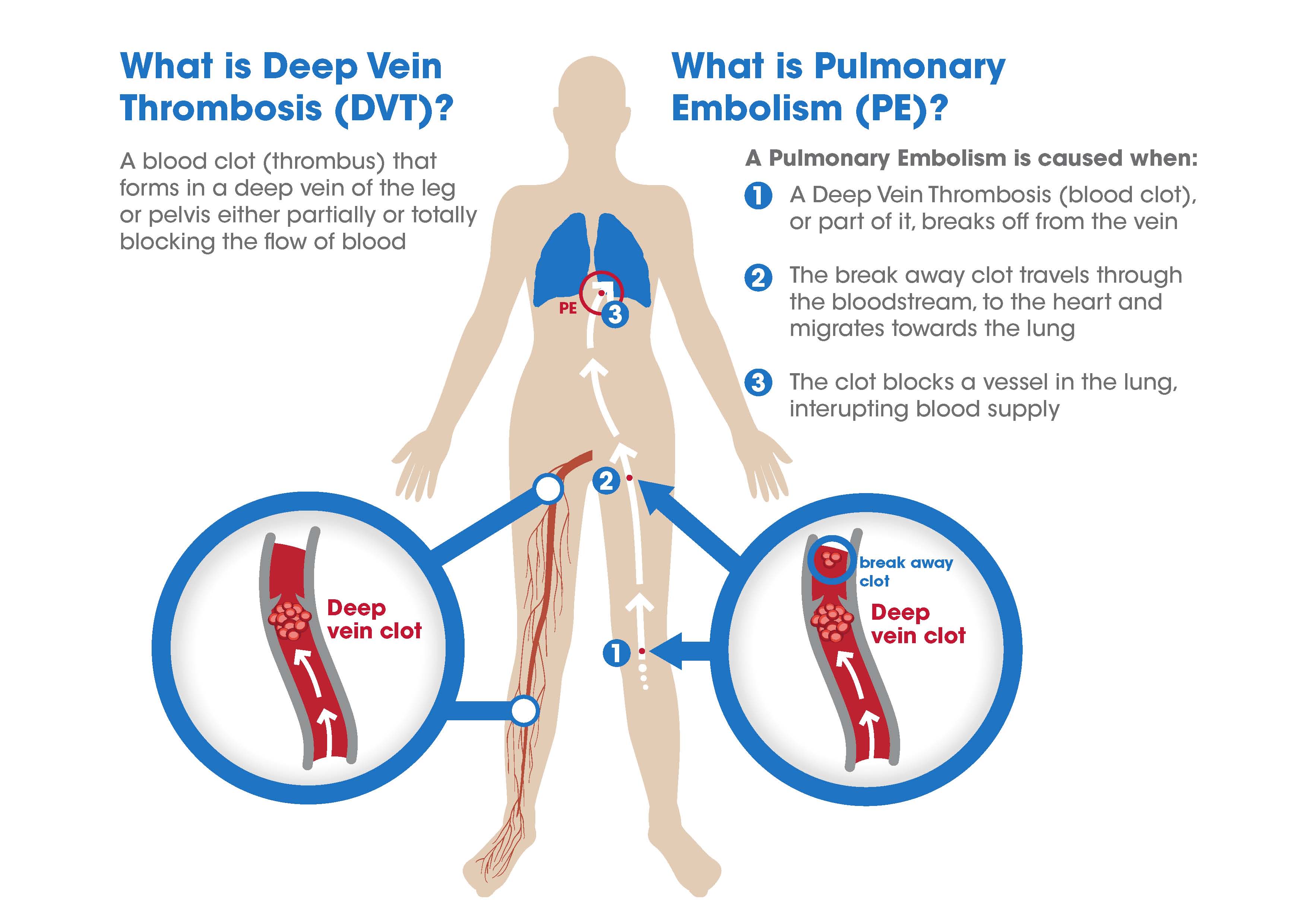 Straight, No Chaser Pulmonary Embolus (A Blood Clot in