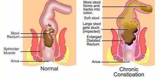 Normal vs. chronic constipation diagram.