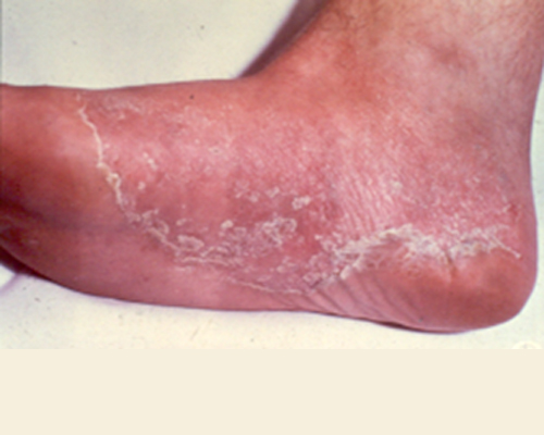 Straight, No Chaser: Athlete's Foot (Tinea Pedis) - Jeffrey Sterling, MD